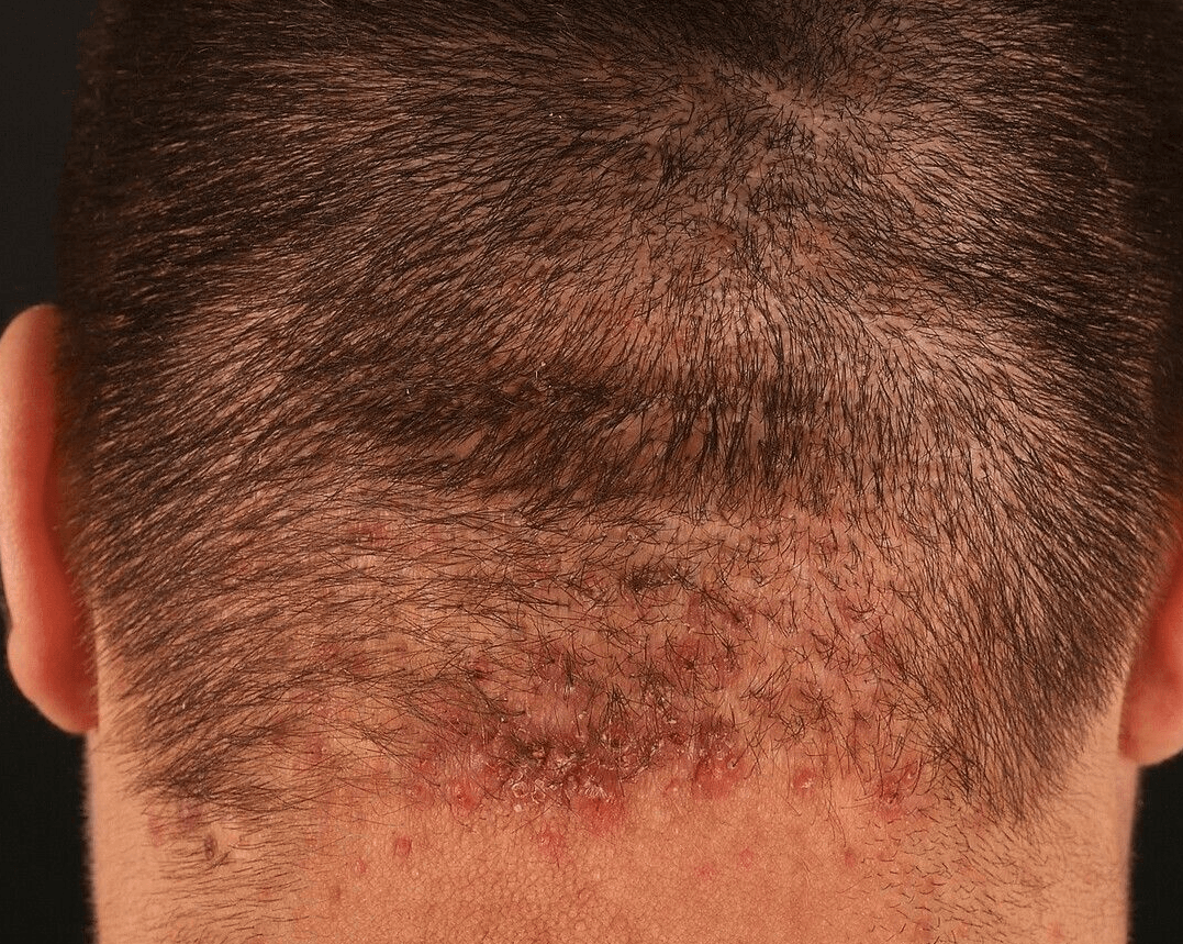 acne keloidalis nuchae