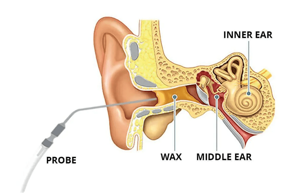 Ear wax microsuction at RPM Health Ear wax microsuction