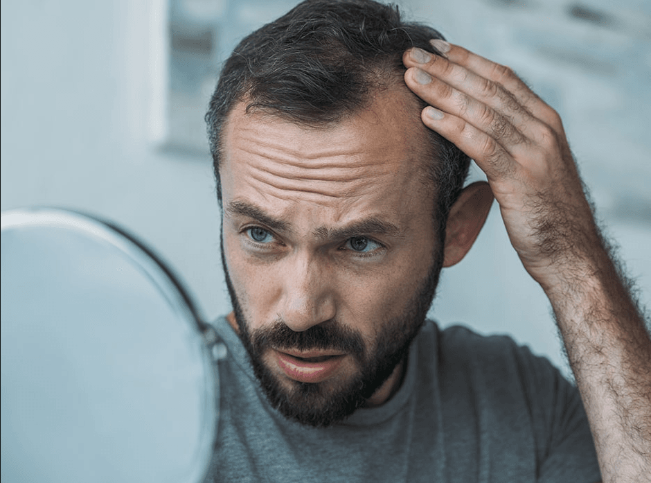 hair loss male