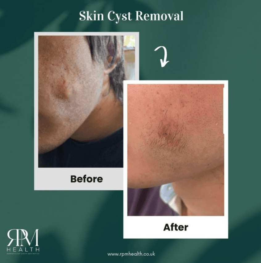 Screenshot 2024-11-15 143711 Before and after , cheek skin cyst