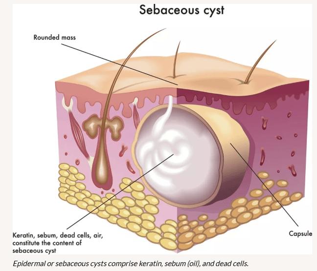 Sebaceous cyst Skin cyst , Sebaceous cyst