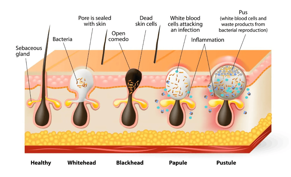acne stages
