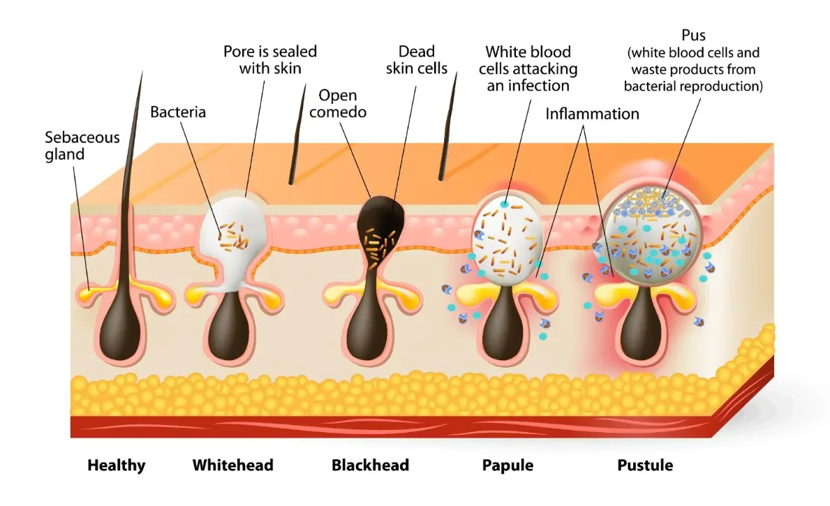 acne stages