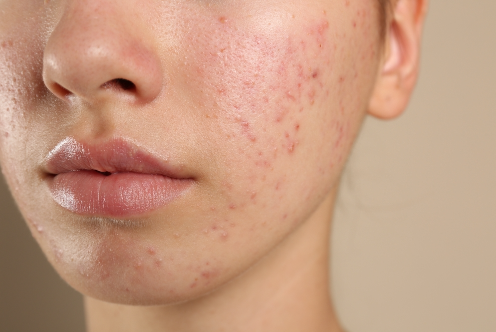 acne vulgaris