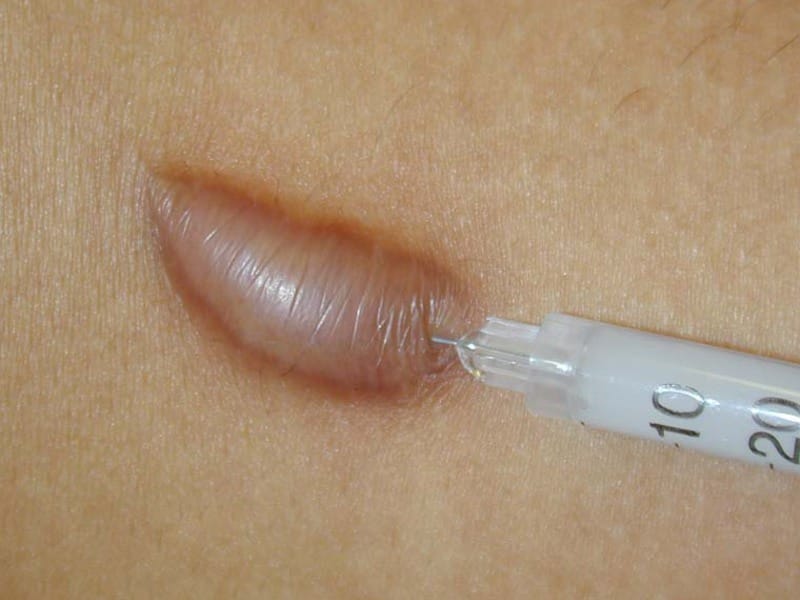 keloid scar injection